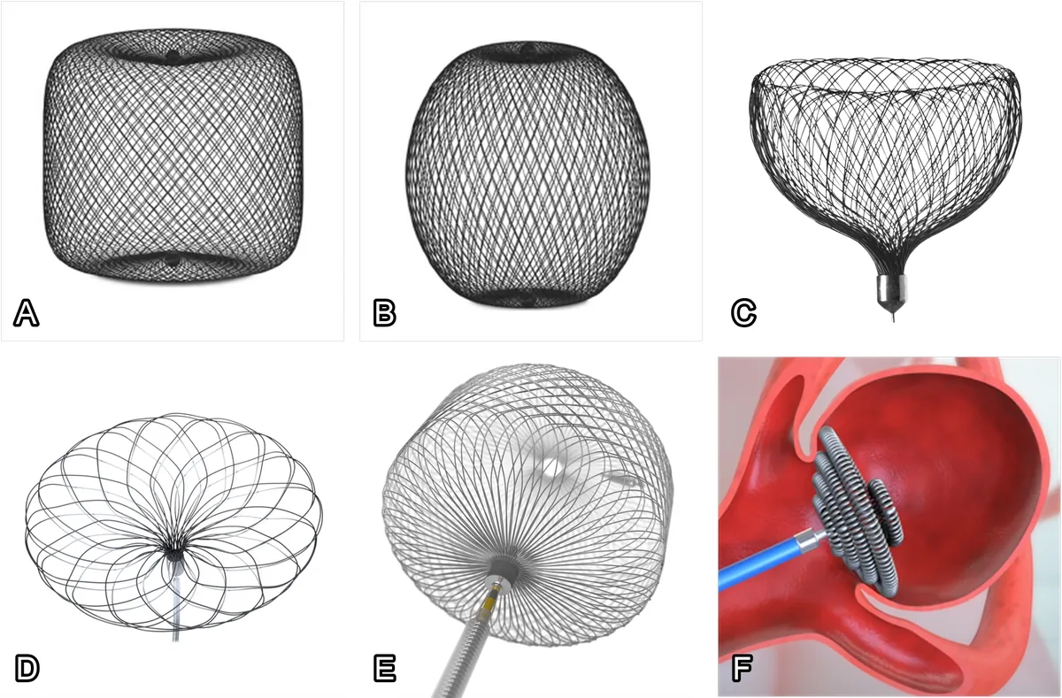 Intrasaccular devices for aneurysm treatment: (A) WEB SL. (B) WEB SLS. (C) Contour. (D) Neqstent. (E) Artisse. (F) Nautilus. Courtesy of Microvention, Stryker, Medtronic, and Endostream.