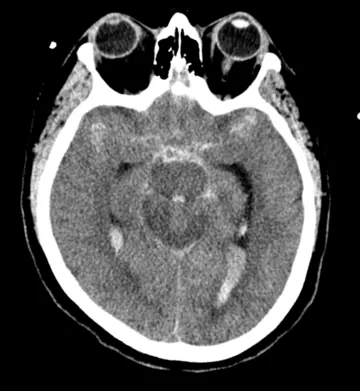 Figure 2: CT scan of a ruptured aneurysm showing blood around the brain.