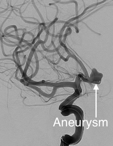 Angiogram of an aneurysm.