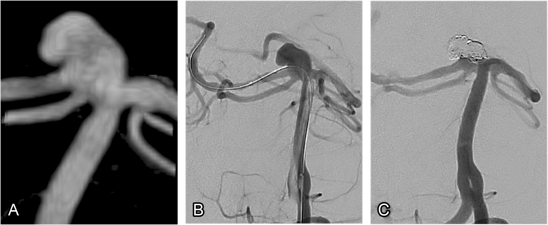Real case of coil embolisation of a cerebral aneurysm. (A) 3-dimensional representation of the aneurysm is acquired, used for planning the rest of the procedure. (B) Angiography of the aneurysm is performed. (C) The aneurysm has had several coils inserted, ensuring that blood no longer fills it.