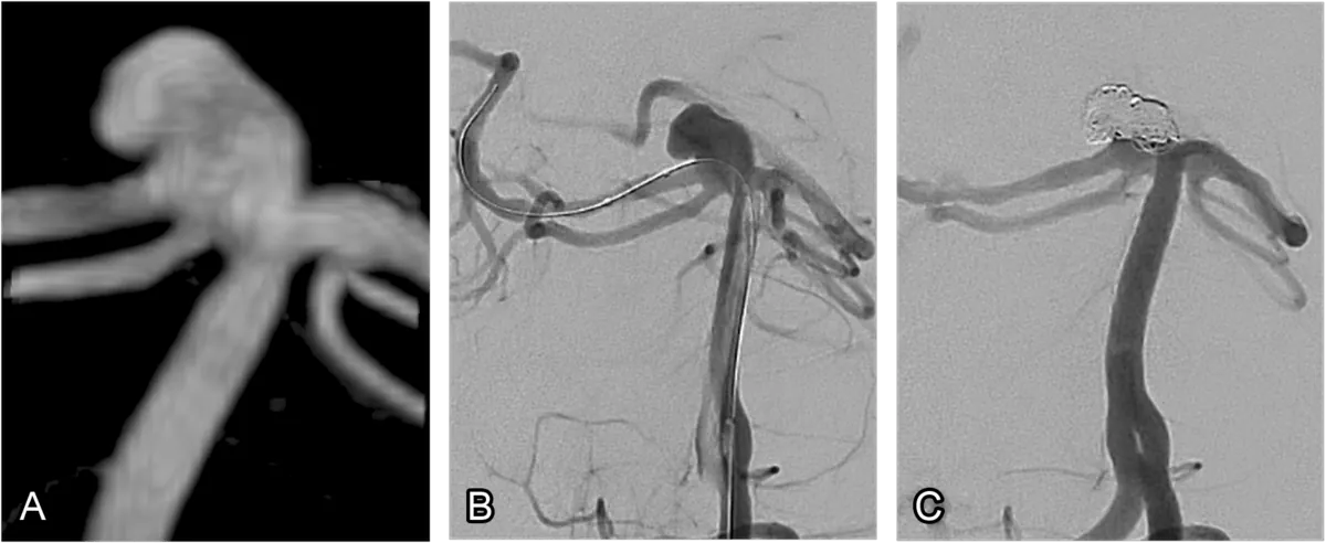 Real case of coil embolisation of a cerebral aneurysm. (A) 3-dimensional representation of the aneurysm is acquired, used for planning the rest of the procedure. (B) Angiography of the aneurysm is performed. (C) The aneurysm has had several coils inserted, ensuring that blood no longer fills it.