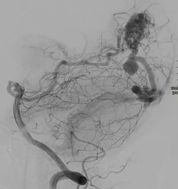 Figure 2: Cerebral angiogram of an AVM located in the occipital lobe (back of the brain).