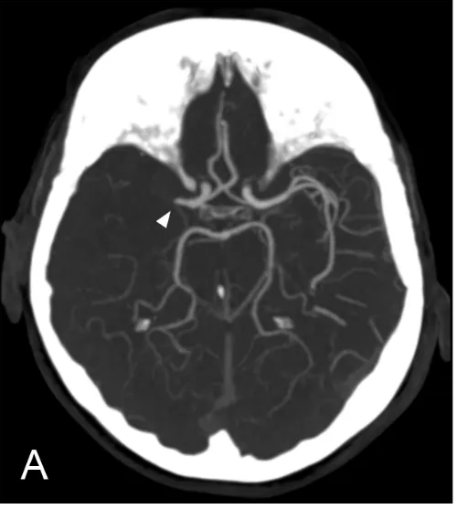 Figure 2: CT angiogram of a patient with a stroke. The arrow shows a blockage in the blood vessel, where the contrast (and therefore also blood) cannot pass.