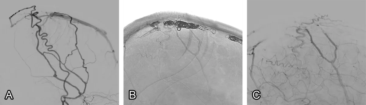 Figure 1: Dural fistula embolisation. (A) A DAVF is seen towards the top of the head. (B) Coils are placed, blocking the blood flow. (C) The fistula is gone at the end of the procedure.
