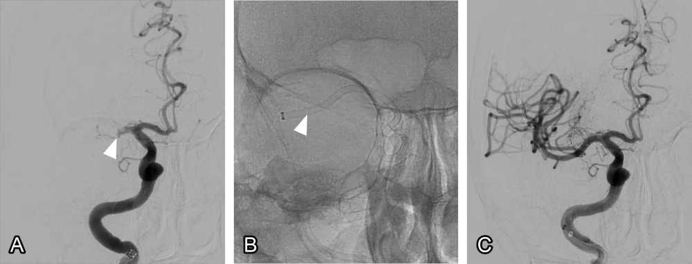 Figure 1: Mechanical thrombectomy. (A) The arterial blood flow is obstructed at the arrow by a blood clot. (B) A long tube called an aspiration catheter is inserted into the artery and suction is applied. (C) The clot is sucked out and the blood flow into the smaller arteries is restored.
