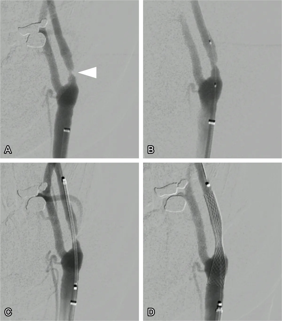 Figure 1: Carotid stenting. (A) Angiography of the carotid artery showing a narrowing (arrowhead). (B) A balloon has been inserted into the narrowing to expand it. (B) The stent is then inserted but is constrained within its container sheath. (C) The stent is unsheathed across the stenosis.