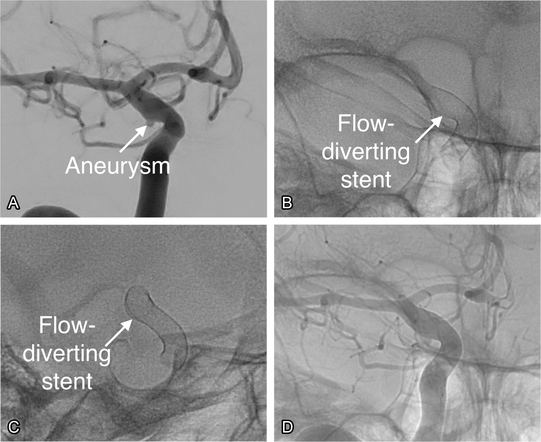 Real case of flow diversion of a cerebral aneurysm. (A) An aneurysm is seen of the internal carotid artery (ICA). (B) A flow-diverting stent is deployed across the neck of the aneurysm. (C) The flow-diverting stent is seen from a different angle. (D) The stent is seen within the blood vessel.