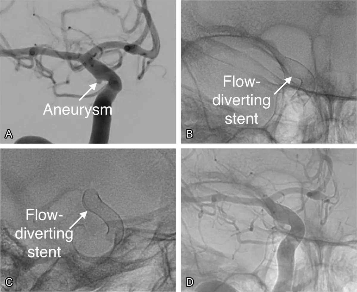 Real case of flow diversion of a cerebral aneurysm. (A) An aneurysm is seen of the internal carotid artery (ICA). (B) A flow-diverting stent is deployed across the neck of the aneurysm. (C) The flow-diverting stent is seen from a different angle. (D) The stent is seen within the blood vessel.