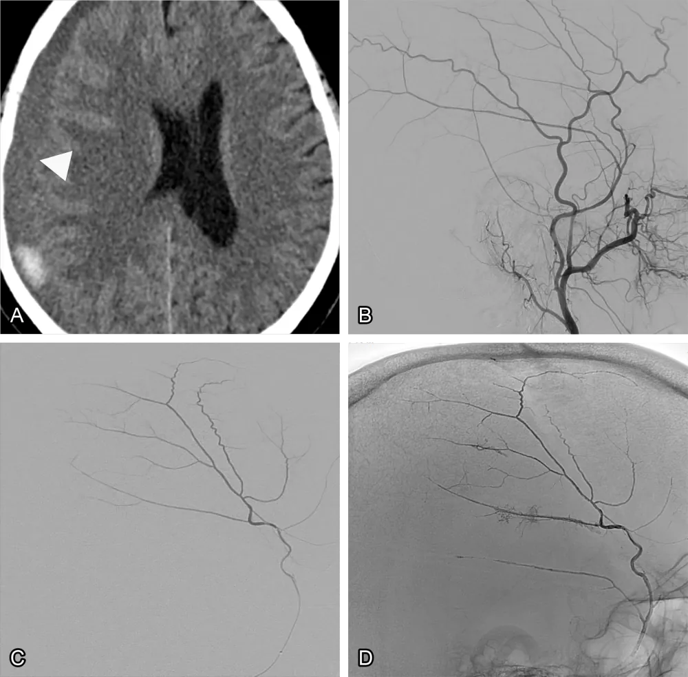 Figure 1: Middle meningeal embolisation of a subdural haematoma. (A) A CT scan of a subdural haematoma (arrowhead). (B) Angiography of the external carotid artery. (C) Selective angiography of the middle meningeal artery. (D) After injection of an embolic agent filling the entire artery.