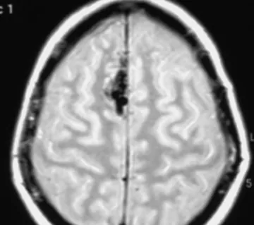 Figure 1: MRI of an AVM.