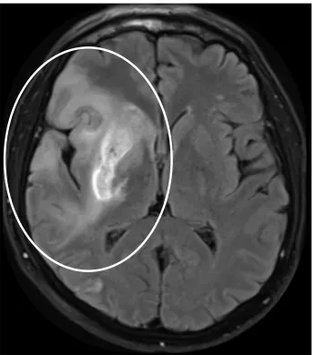 Figure 3: MRI of a patient with a stroke. The brighter region within the circle is the area affected by the stroke.