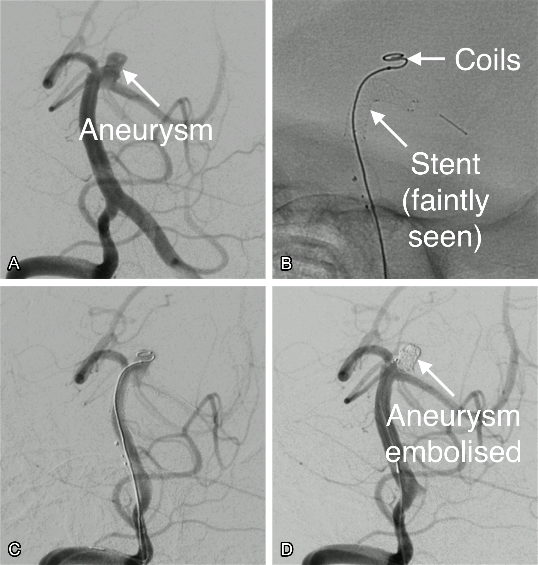 Real case of stent & coil embolisation of a cerebral aneurysm. (A) An aneurysm is seen at the tip of the basilar artery. (B) A stent is deployed across the neck of the aneurysm, and a single coil has been placed in the aneurysm (C) Angiography during placement of the stent. (D) The aneurysm has been filled with coils.