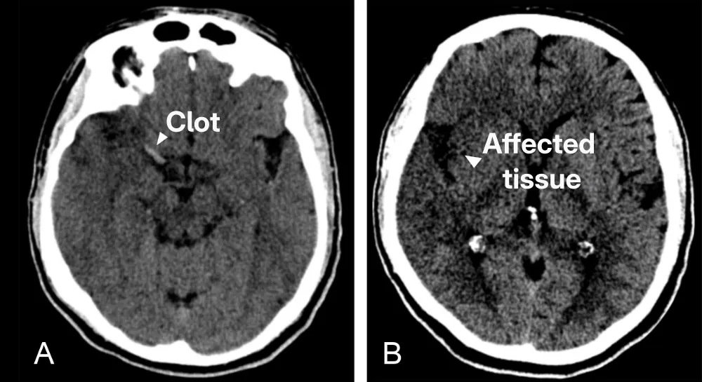 Figure 1: CT scan of the brain of a patient with stroke. (A) Shows the bright clot. (B) Shows the darker region where the brain has not received enough blood.